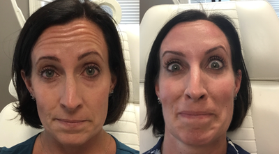 Botox before and after photo