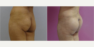 Butt Implants before and after photo