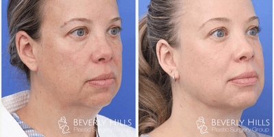 FaceTite before and after photo