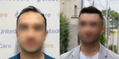 FUE Hair Transplant before and after photo