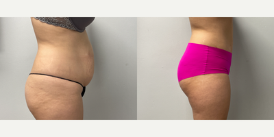 Tummy Tuck before and after photo