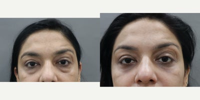 Eyelid Surgery before and after photo