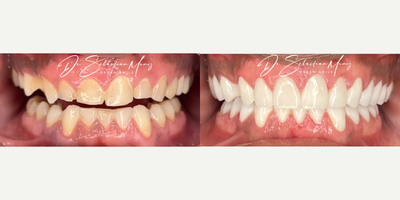 Porcelain Veneers before and after photo