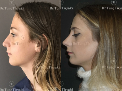 Rhinoplasty before and after photo