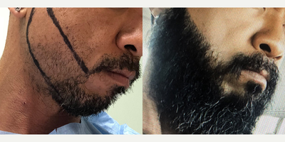 Beard Transplant before and after photo