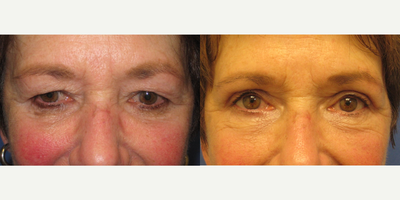 Eyelid Surgery before and after photo