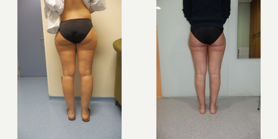 Liposuction before and after photo