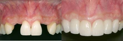 Dental Implants before and after photo