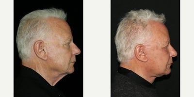 Facial Fat Transfer before and after photo