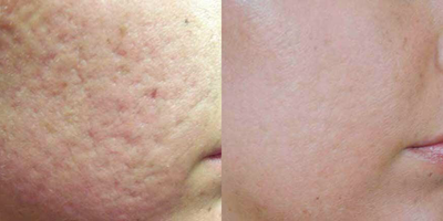 Laser Resurfacing before and after photo