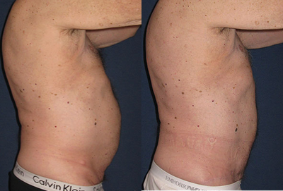 Liposuction before and after photo