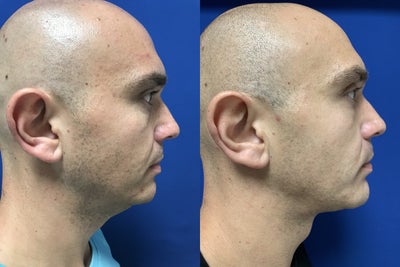 Chin Implant before and after photo