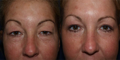 Eyelid Surgery before and after photo