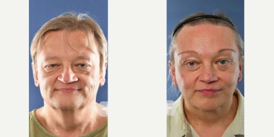 Facial Feminization Surgery before and after photo