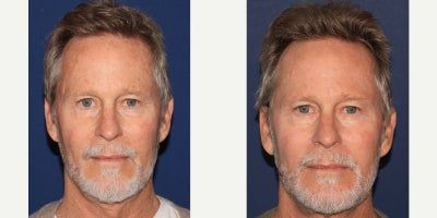 Fractional Laser before and after photo
