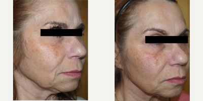 Botox before and after photo