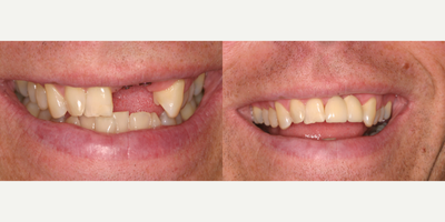 Dental Implants before and after photo