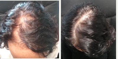 Hair Loss Treatment before and after photo