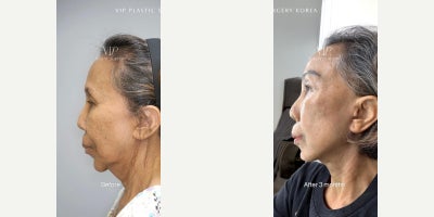 Neck Lift before and after photo