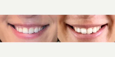 Botox before and after photo