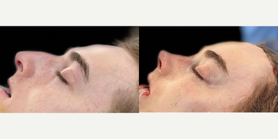 Brow Lift before and after photo