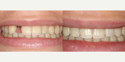 Dental Implants before and after photo