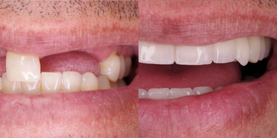 Dental Implants before and after photo