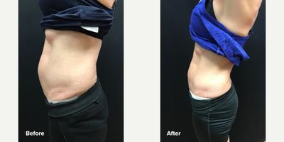 Emsculpt before and after photo