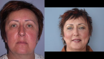 Eyelid Surgery before and after photo