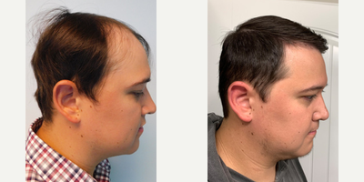 Hair Loss Treatment before and after photo