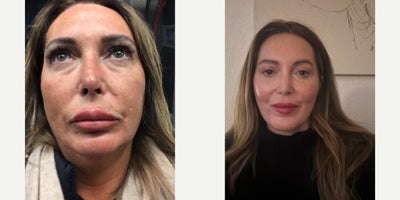Neck Lift before and after photo