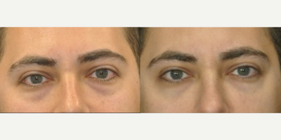 Vollure before and after photo