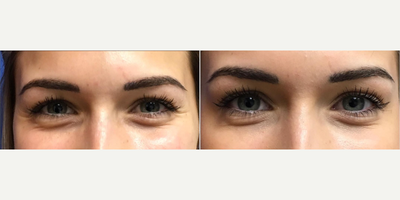 Botox before and after photo