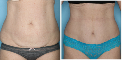 Mini Tummy Tuck before and after photo