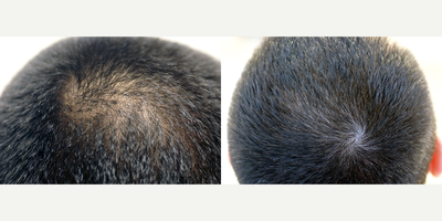 PRP for Hair Loss before and after photo