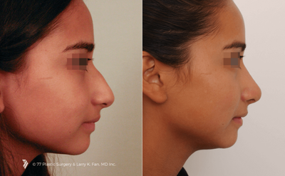 Rhinoplasty before and after photo