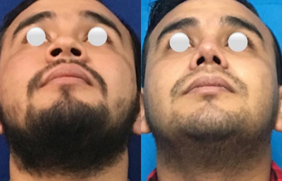 Rhinoplasty before and after photo
