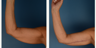 Vaser Liposuction before and after photo