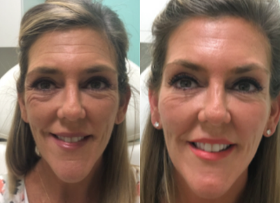 Botox before and after photo