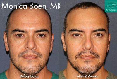Botox before and after photo