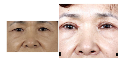 Double Eyelid Surgery before and after photo