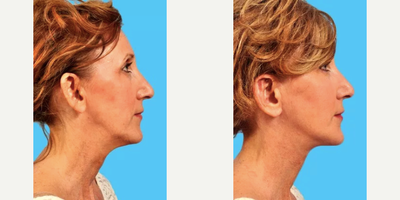 Ear Surgery before and after photo