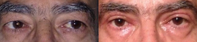 Eyelid Surgery before and after photo