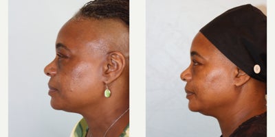 Eyelid Surgery before and after photo