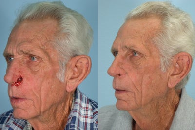 Facial Reconstructive Surgery before and after photo