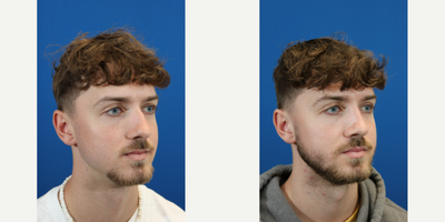Rhinoplasty before and after photo