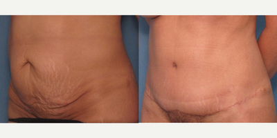 Tummy Tuck before and after photo
