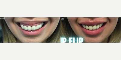 Dermal Fillers before and after photo