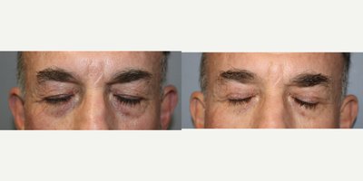 Eyelid Surgery before and after photo