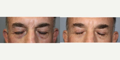 Eyelid Surgery before and after photo